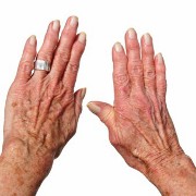 Arthritis related image